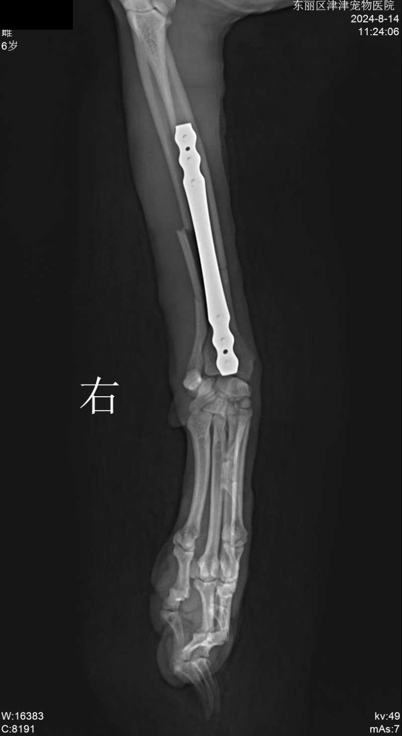 球球桡尺骨骨折固定影像