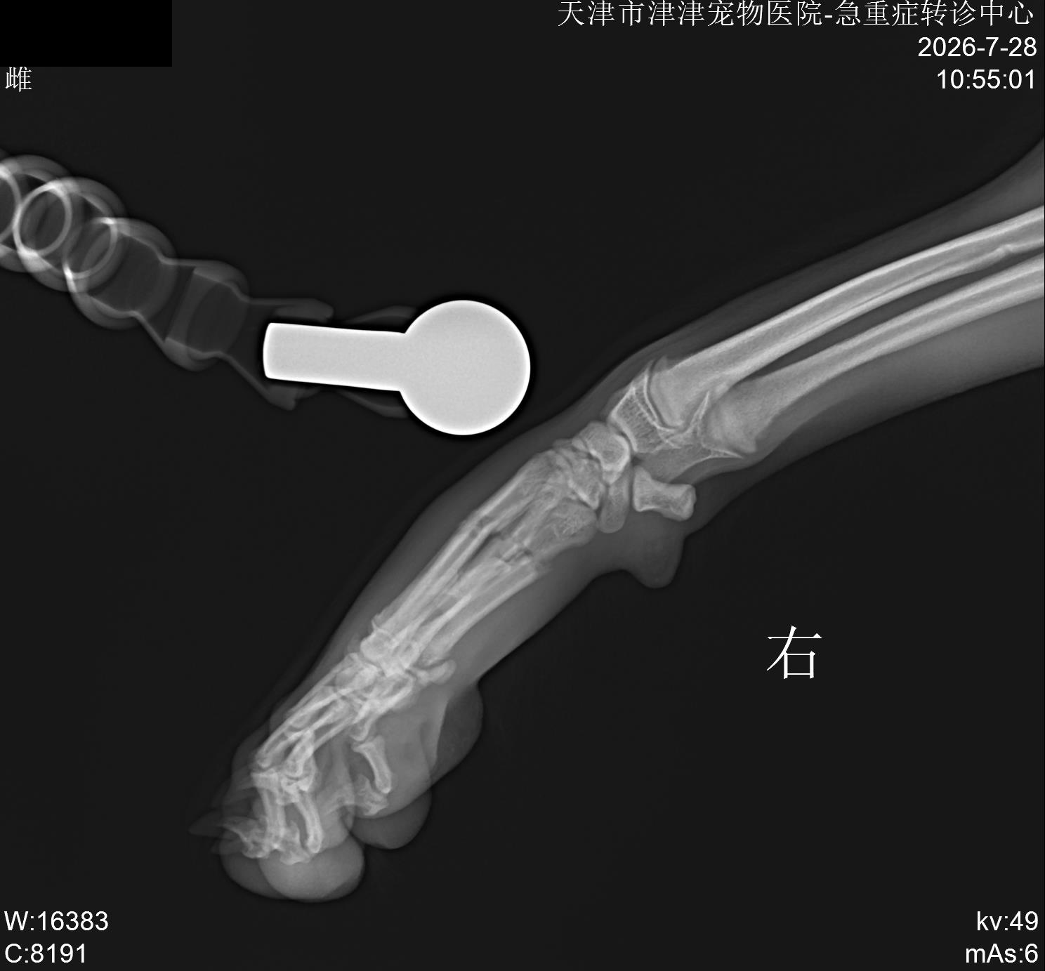 圆圆多根掌骨骨折钢板固定影像